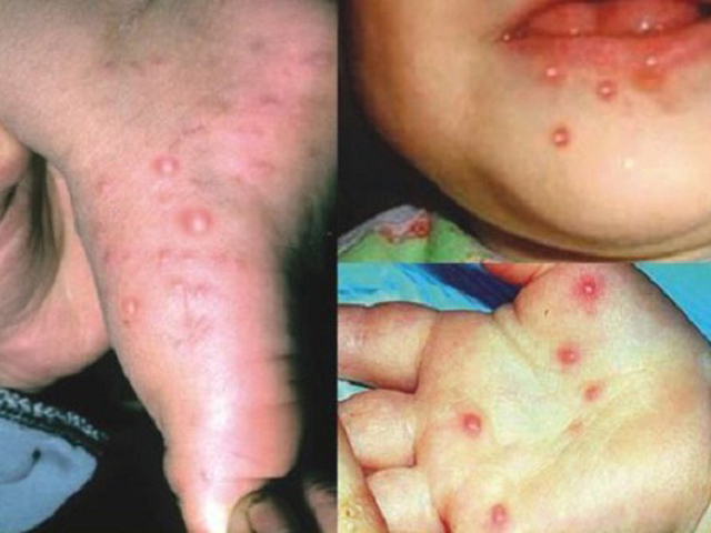 Con gặp nguy hiểm vì cha mẹ nhầm bệnh chân tay miệng với dị ứng da