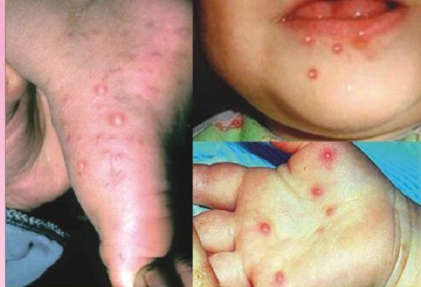 Con gặp nguy hiểm vì cha mẹ nhầm bệnh chân tay miệng với dị ứng da - 1