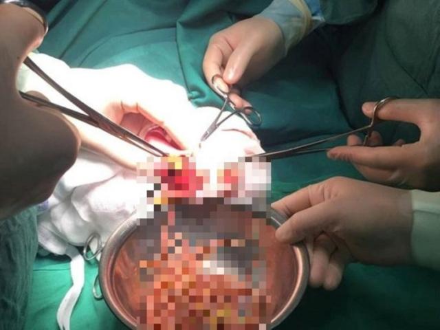 Bị đau bụng 6 ngày không khỏi, bác sĩ lôi ra túi giun lớn từ bụng bé gái 3 tuổi