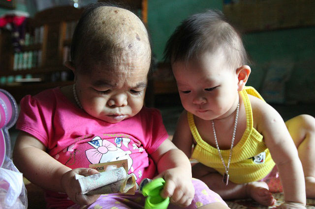 Cô gái 9X mang hình hài đứa trẻ lên 2, nuôi hơn 20 năm mãi không thể lớn - 3