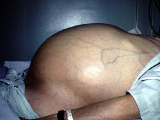 Nguyên nhân gây ung thư gan ít ai ngờ và dấu hiệu nhận biết ung thư gan