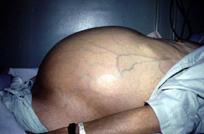 Nguyên nhân gây ung thư gan ít ai ngờ và dấu hiệu nhận biết ung thư gan - 1