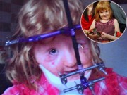 Làm mẹ - Mắc bệnh giống bé Bôm, trải qua 16 cuộc phẫu thuật, bé gái Anh khiến nhiều người không nhận ra