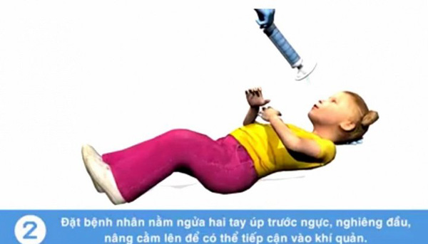 Tử vong do sặc cháo: Nếu biết cách cấp cứu kịp thời có thể cứu mạng trẻ - 3
