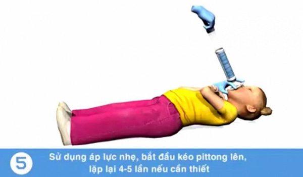 Tử vong do sặc cháo: Nếu biết cách cấp cứu kịp thời có thể cứu mạng trẻ - 6