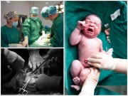 Bà bầu - Khi đau đẻ ai cũng đòi mổ nhưng mẹ có biết một ca sinh mổ đau đớn thế nào không?