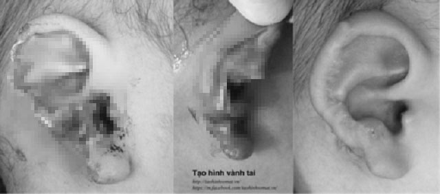 Sang nhà hàng xóm chơi, cháu bé 18 tháng tuổi bị chó cắn nát tai - 1