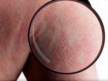 Những điều cơ bản bạn nhất định phải biết về bệnh vảy nến
