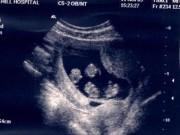 Tin tức - Chuẩn bị thụ tinh nhân tạo thì phát hiện mang thai, kết quả siêu âm còn bất ngờ hơn nữa