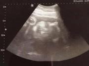 Bà bầu - 10 năm uống thuốc tránh thai, mẹ sững người khi phát hiện có bầu, 4 tuần sau đã đẻ