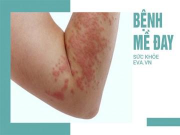 Bệnh mề đay gây ngứa ngáy, xử lý ra sao?