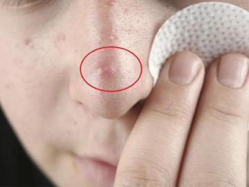 Cách trị mụn bọc trả lại làn da căng bóng, ai mà không biết là phí cả đời!