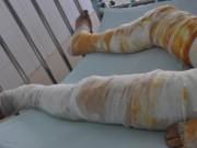 Sức khỏe - Từ trường hợp bị bỏng khi đi mát xa chân, bác sĩ hướng dẫn cách sơ cứu an toàn nhất