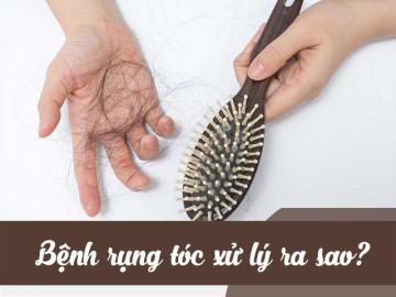 Rụng tóc xử lý thế nào?