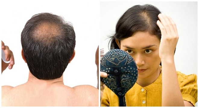 Kỹ thuật dệt tóc hói 3D giúp tạm biệt ngay “đường bay sáng chói” ở trên đầu - 1
