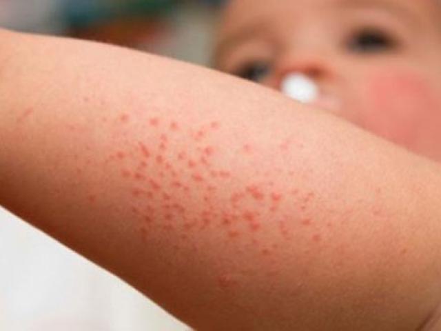 Dị ứng nước - căn bệnh kỳ lạ hiếm gặp nhưng có thật