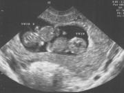 Bà bầu - Vỡ òa khi bác sĩ siêu âm nói mang thai đôi, mẹ "chết đứng" khi sinh ra con 2 đầu