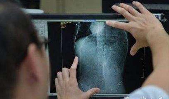 Anh chàng bị xơ gan, chỉ uống một loại thuốc bổ cuối cùng bác sĩ nói không thể cứu chữa - 2