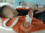 Làm mẹ - Mải chơi điện tử trên điện thoại đang sạc, bé 9 tuổi ngực cháy đen sì