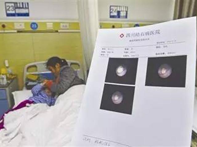 Để 2 con ở nhà chăm nhau, bố mẹ không ngờ điều này vô tình khiến con bị sỏi thận