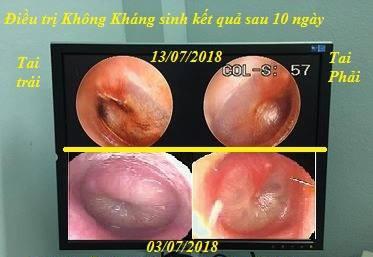Bị viêm tai giữa dùng 1 tháng kháng sinh không đỡ, bé khỏi bệnh sau 10 ngày với cách này - 3