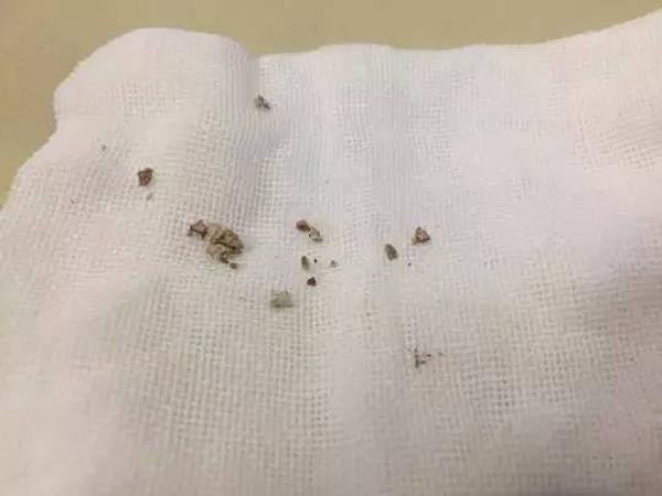 Để 2 con ở nhà chăm nhau, bố mẹ không ngờ điều này vô tình khiến con bị sỏi thận - 2