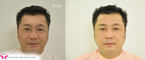 Đến Trung tâm Chống lão hóa Xuân Hùng làm đẹp với giá siêu ưu đãi trong dịp sinh nhật - 5