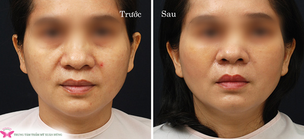 Đến Trung tâm Chống lão hóa Xuân Hùng làm đẹp với giá siêu ưu đãi trong dịp sinh nhật - 6