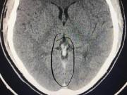 Sức khỏe - Nhìn phim chụp X-quang, chàng trai giật mình biết được lý do mình đau đầu không hề đơn giản