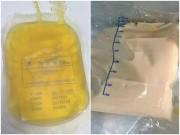 Sức khỏe - Bác sĩ giật mình khi máu bệnh nhân có lớp váng như mỡ, do ăn những món ai cũng thích