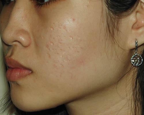 Có nhiều cách để điều trị những vết sẹo rỗ này, dù bạn có bao nhiêu lỗ trên mặt, chúng cũng sẽ hết sau 2 tuần - 1