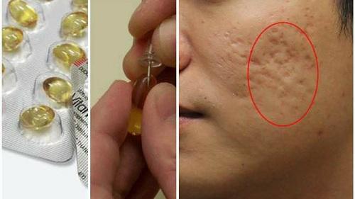 Có những cách trị sẹo rỗ này, dù có bao nhiêu lỗ trên mặt cũng có thể liền lại chỉ sau hai tuần - 4