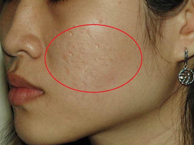 Có những cách trị sẹo rỗ này, mặt lỗ chỗ đến mấy cũng được san bằng chỉ sau 2 tuần
