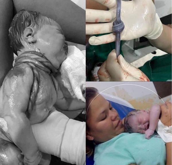Em bé gây kinh ngạc khi chào đời với 5 vòng dây rốn quấn cổ và một nút thắt - 1