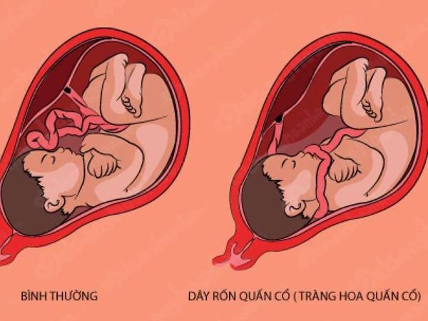 Em bé gây kinh ngạc khi chào đời với 5 vòng dây rốn quấn cổ và một nút thắt - 3