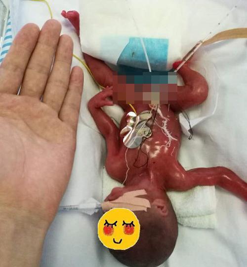 Bé sinh non nhỏ bằng bàn tay mẹ, bác sĩ liên tục thông báo gia đình amp;#34;chuẩn bị tinh thầnamp;#34; - 1