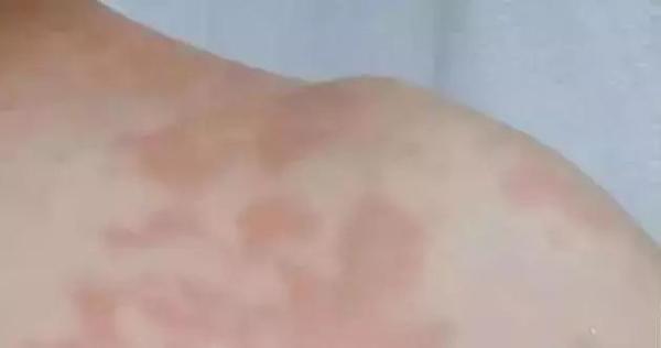 Chân bỗng nhiên đau nhói, ngứa ngáy, người đàn ông chỉ kịp nói một câu rồi nhập viện - 2