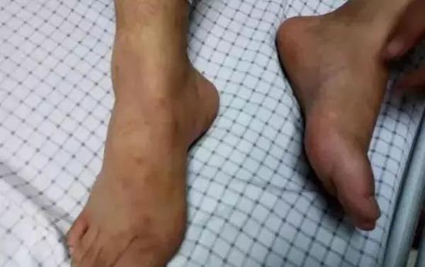 Chân bỗng nhiên đau nhói, ngứa ngáy, người đàn ông chỉ kịp nói một câu rồi nhập viện - 3