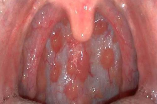 Triệu chứng viêm họng hạt là gì? - 2