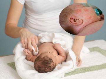 Bác sĩ Da liễu Trung ương mách mẹ cách chăm sóc viêm da cơ địa ở trẻ