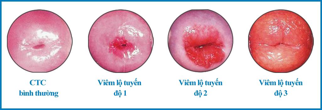 Khí hư bất thường, cẩn thận kẻo mắc viêm lộ tuyến cổ tử cung độ 1 - 2