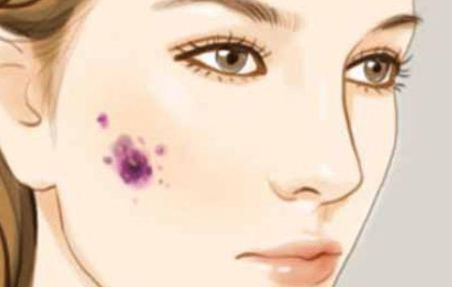 Cô gái 26 tuổi bị ung thư sau khi tẩy nốt ruồi, 10 kiểu nốt ruồi cần đi khám gấp - 1