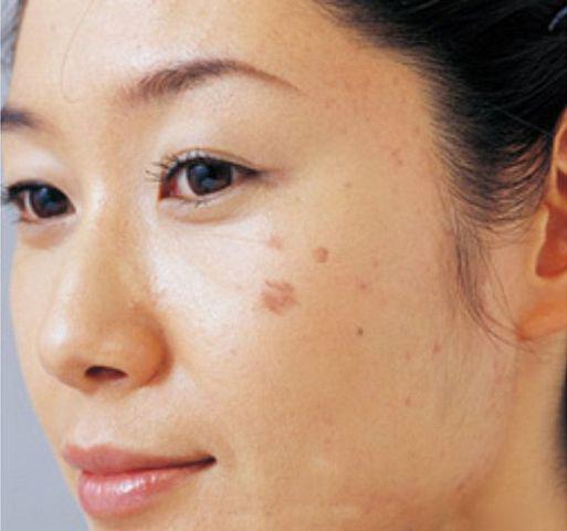 Cô gái 26 tuổi bị ung thư sau khi tẩy nốt ruồi, 10 kiểu nốt ruồi cần đi khám gấp - 5