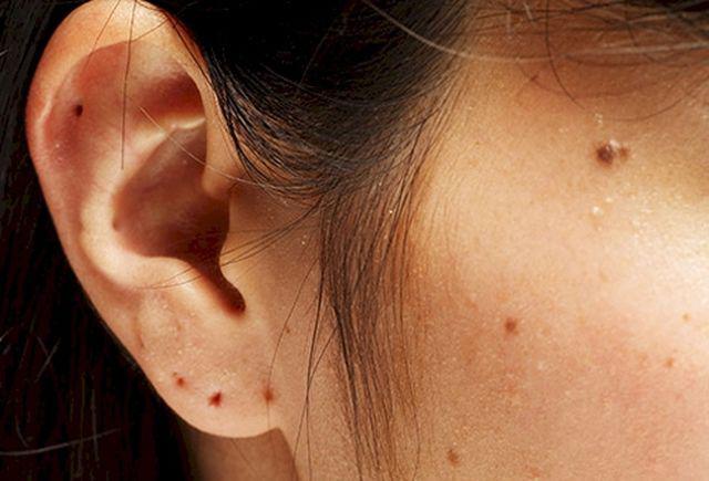 Cô gái 26 tuổi bị ung thư sau khi tẩy nốt ruồi, 10 kiểu nốt ruồi cần đi khám gấp - 3
