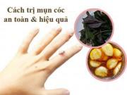 Bằng cách tận dụng nguyên liệu có sẵn trong bếp, bạn sẽ có ngay cách trị mụn cóc tận gốc