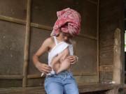 Tin tức - Mẹ không khám khi mang thai, con gái có "chị em song sinh" đầy đủ tay chân dính trước ngực