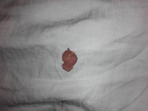 Thấy vệt máu trên giường sau tân hôn, chồng rất mừng nhưng không lâu sau phải đưa vợ đi khám - 1