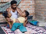 Tin tức - Chuyện tình kỳ lạ của cặp chị em song sinh dính liền thân cùng yêu một chàng trai