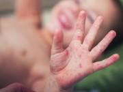 Làm mẹ - Dấu hiệu bệnh tay chân miệng ở trẻ rõ rệt nhất