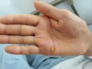Sức khỏe - Cứng hàm, mất cảm giác vì vết thương nhỏ như đầu tăm đâm vào bàn tay